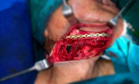 Jaw Bone Cancer Treatment
